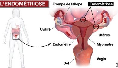 Endometriose