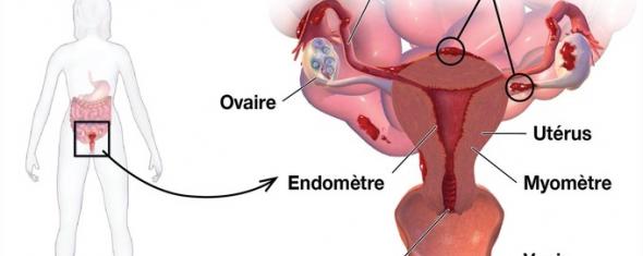 L'endométriose, une maladie féminine méconnue | e3n